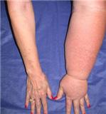 Lymphoedema